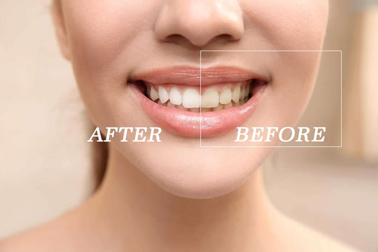 What Are the Most Effective Natural Teeth Whitening Methods You Can Try Cannock?