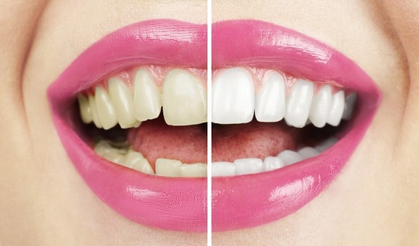 What Makes Ultima White Teeth Whitening Different Cannock