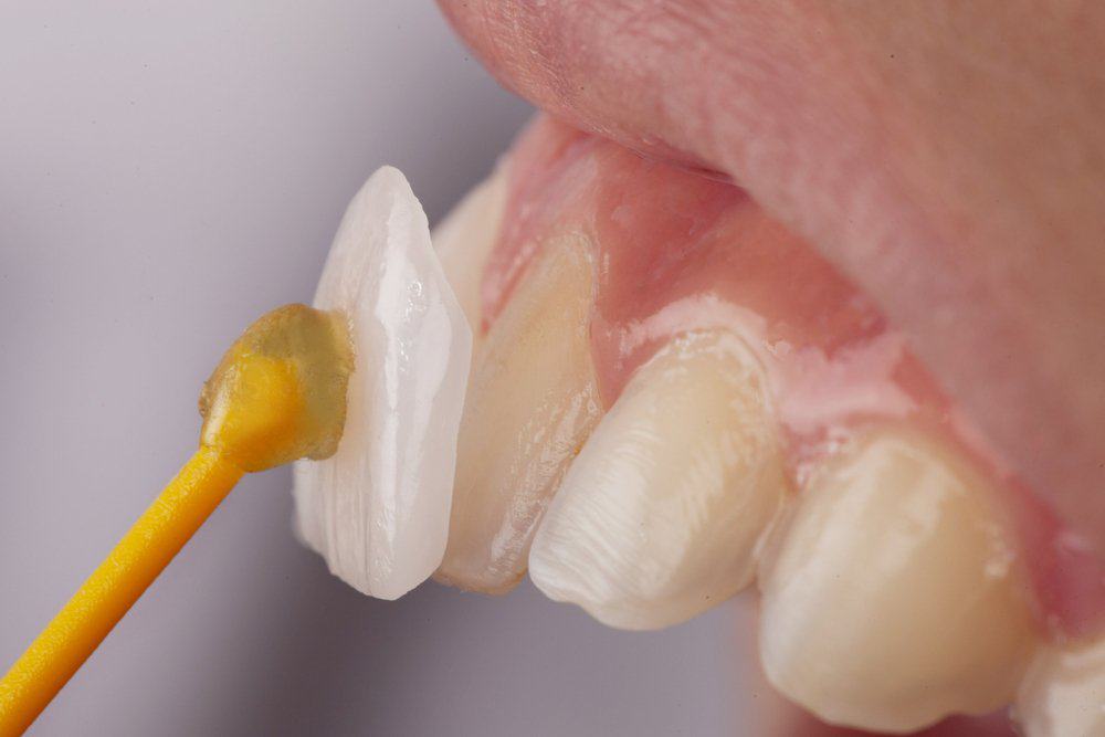 Dental Veneers: Achieving a Flawless Look Cannock