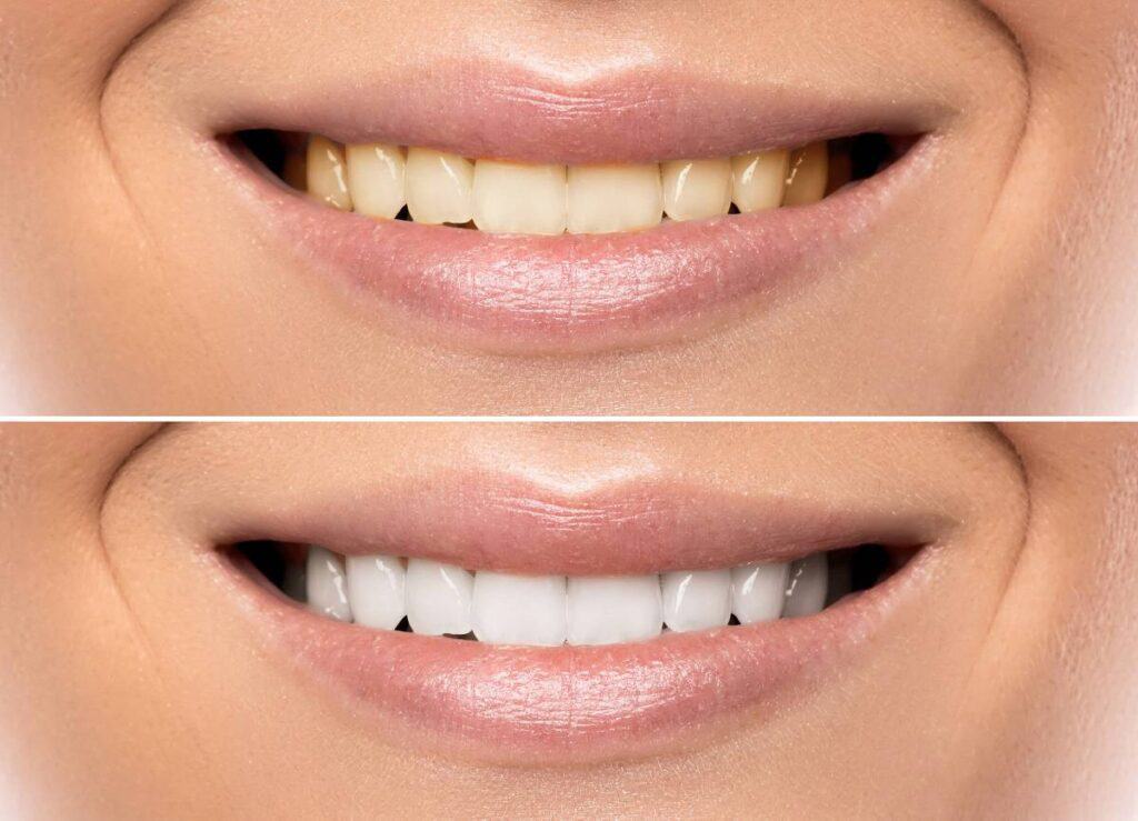 How Does Gum Disease Progress if Left Untreated Cannock?