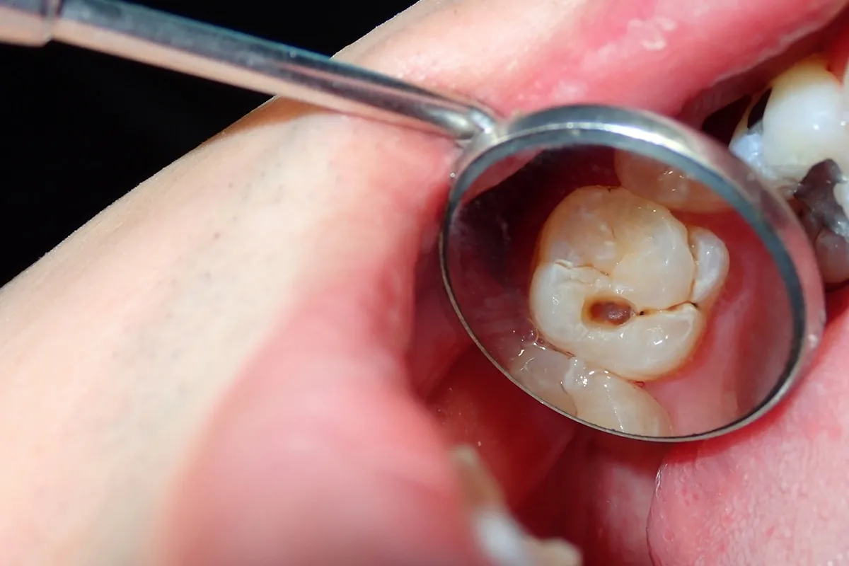 Why Do Teeth Crack? Common Causes to Know Cannock