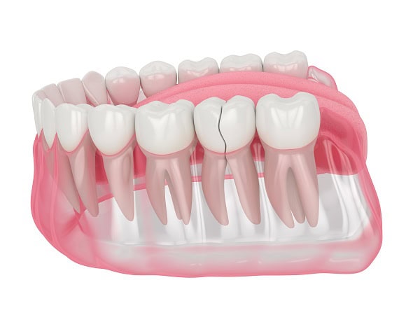 How Can You Manage Pain and Discomfort After a Root Canal Cannock?