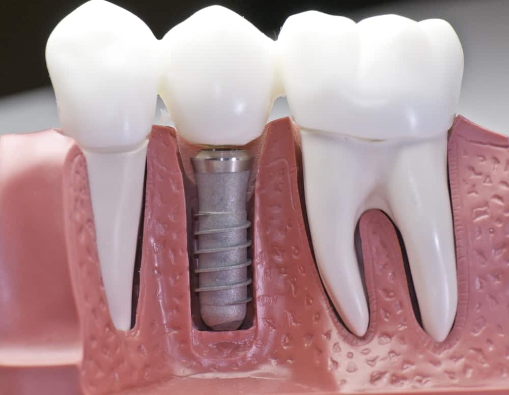 Common Misconceptions About Modern Dental Treatments Cannock