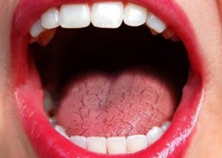 Common Causes of Dry Mouth (Xerostomia) Cannock