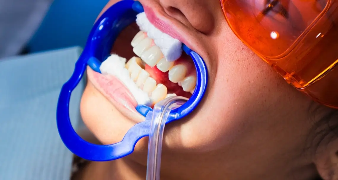 What Side Effects Can You Experience After Laser Teeth Whitening Cannock?