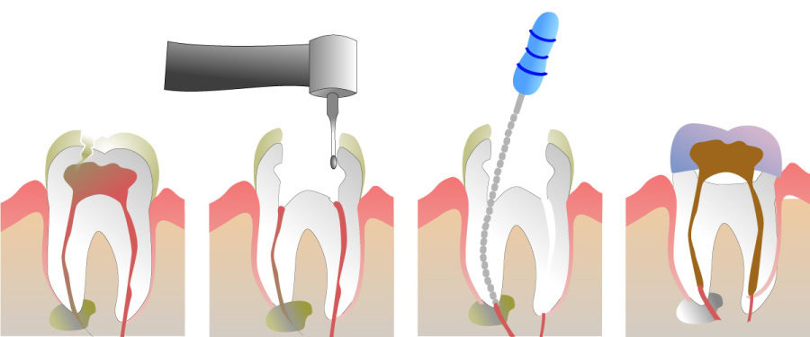 How Do You Properly Care for Your Teeth After a Root Canal Cannock