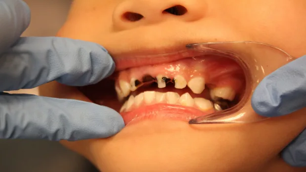 Which Foods and Drinks Cause the Most Damage to Young Smiles Cannock?
