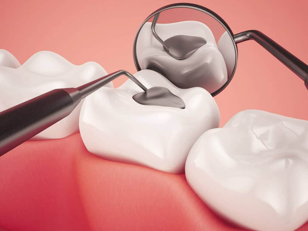 How Can You Prevent Tooth Decay Effectively Cannock