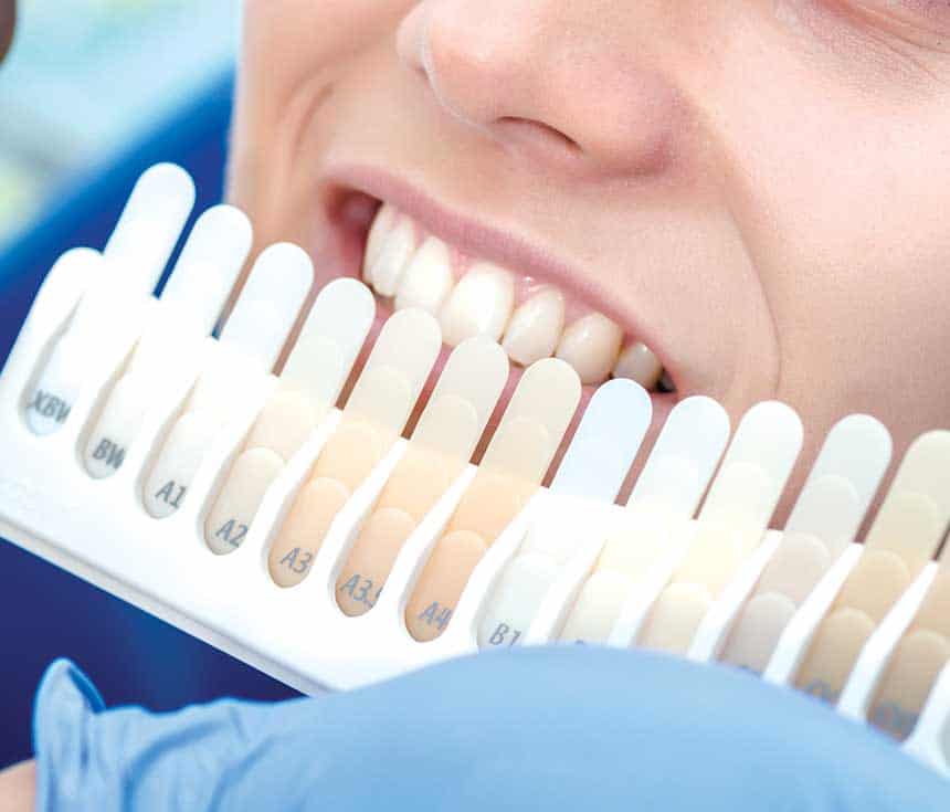 Professional vs At-Home Whitening: What You Need to Know Cannock