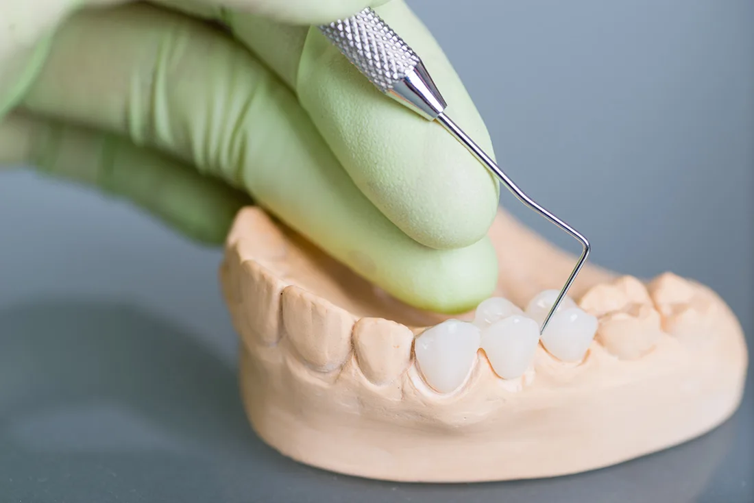 Do Braces Take Years to Show Results Cannock