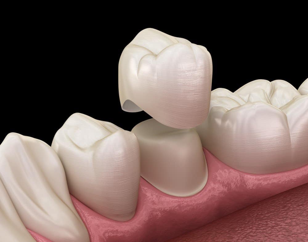 What Daily Habits Help Protect Your Dental Crowns Cannock?