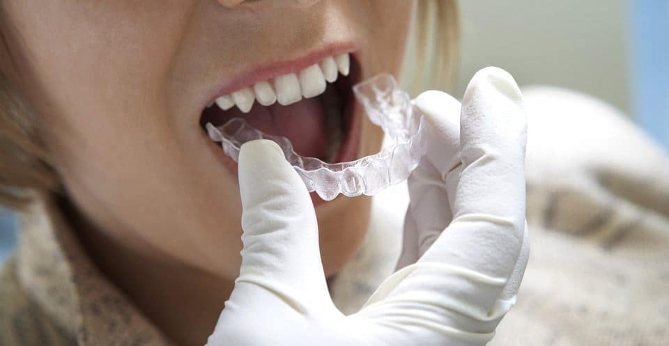 Can Bruxism Affect Your Sleep Quality Cannock